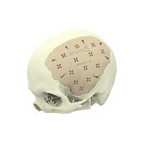 Custom-made cranial implant