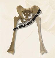 Pelvis external fixation system 40140000100tubularadult