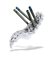 Minimally invasive pedicle screw positioning system Thunderbolt