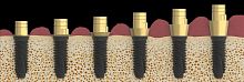 Spiral implant abutment K80 titaniumconicalinternal