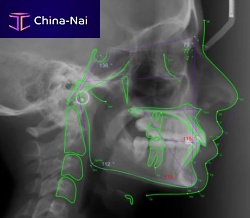 Medical software Romexis®orthodonticsurgicalcephalometric analysis