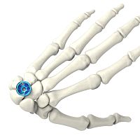 Carpal joint arthrodesis plate ARIX 2.5lockingtitanium