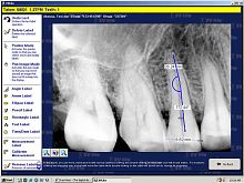 Dental imaging software dentalimage enhancementcapture