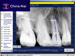 Dental imaging software dentalimage enhancementcapture