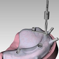 Clinical software RealGUIDEfor dental surgeryfor guided surgeryuniversal