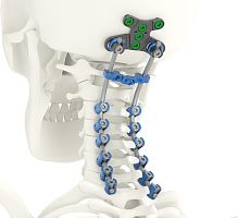 Occipito-cervico-thoracic osteosynthesis unit SOLSTICE®posterioradult