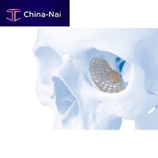 Non-absorbable periorbital implant MatrixORBITAL