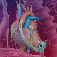 Adult ventricular assist device CH-VAD®