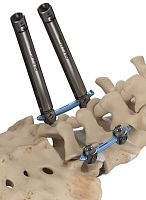 Minimally invasive pedicle screw positioning system Invictus