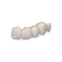 Ceramic dental material Bilayered zirconiafor dental bridgesfor dental crowns