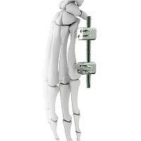 Metacarpophalangeal joint external fixation system minifixtubularpediatric