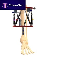 Tibia external fixation system ORTHEXcircularpediatric