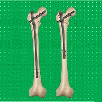Femoral intramedullary nail Neonproximal fixationtitanium