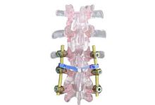 Cervico-thoraco-lumbo-sacral osteosynthesis unit EVOLUTION PLUSposterioradult