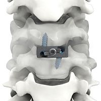 Cervical interbody fusion cage PRO-LINK®anteriortitanium